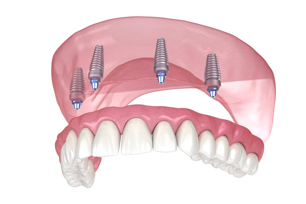 All on 4 Dental Implants Melbourne