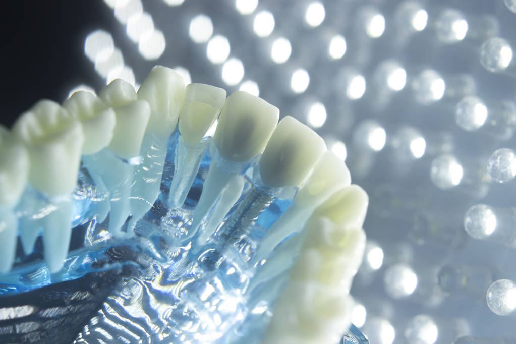 Dental implants Cost Brisbane
