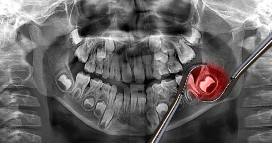 wisdom tooth extractio
